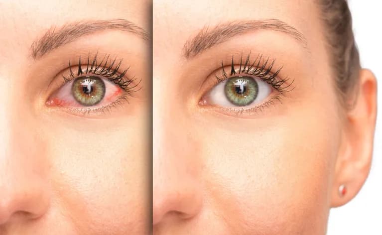 Glaucoma Treatment